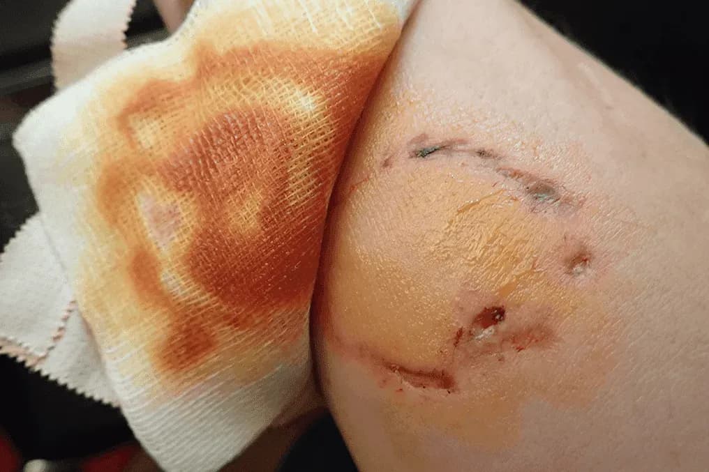 dog-bite-wound-on-a-hand.webp